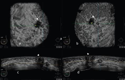 Automatic breast ultrasound: state of the art and future perspectives ...