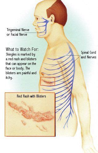 Unfortunately, for one fourth to one half of patients, pain may remain ...