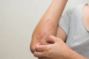 Causes of Itchy Bumps on Elbows and What to Do About This » Scary Symptoms