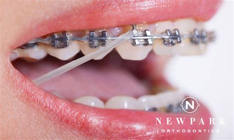 Using Elastics for Braces | Newpark Orthodontics | Alpharetta, GA