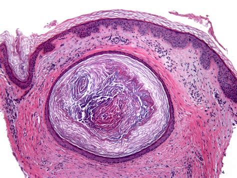 Epidermal (infundibular) cysts