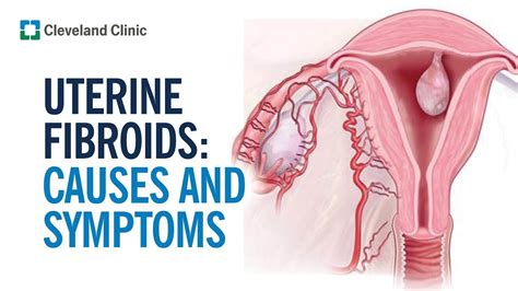 Fibroid Treatment