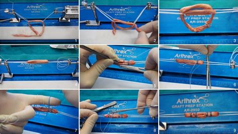 Showing the continuous loop technique using a quadrupled semitendinosus ...