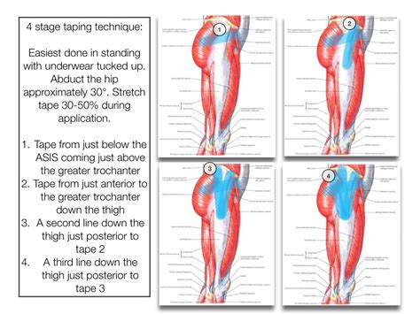 Gluteal Tendinopathy - RunningPhysio