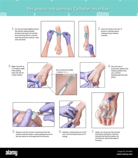 Illustration depicting the proper placement of a peripheral intravenous ...