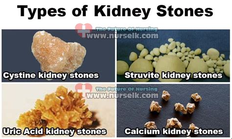 Types of Kidney Stones | Nurselk.com