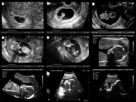 When Is The Baby Visible On A Ultrasound - Baby Viewer