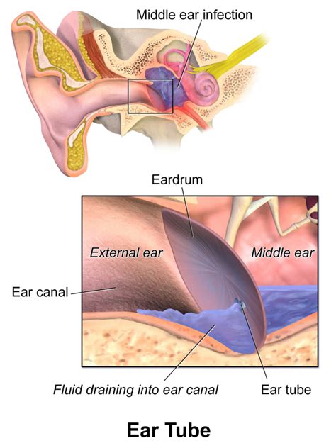 Managing Middle Ear Fluid | Clear Choice Hearing and Balance