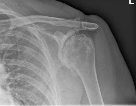 Shoulder Arthritis - KAYVON IZADI MD | HAND WRIST ELBOW ORTHOPEDIC SURGEON