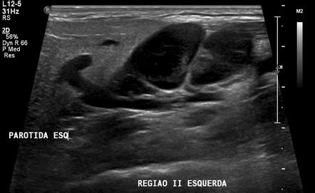 Jugulodigastric lymph node - normal (ultrasound) | Radiology Case ...