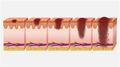 Metastatic Melanoma: Symptoms, Stages, Treatment | Christ Memorial