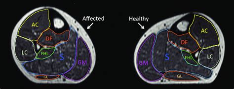 Soleus Muscle Mri