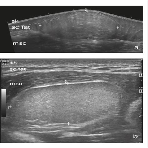 Figure 1 from Ultrasound for diagnosis of soft-tissue lipoma : accuracy ...