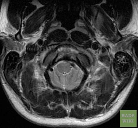 Arnold-Chiari malformation MRI - wikidoc