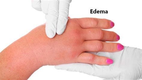 What is Edema? Symptoms, Causes, and Risk Factors – The Inside Experience