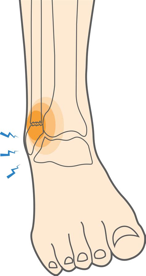 Tibia And Fibula Ankle Fracture