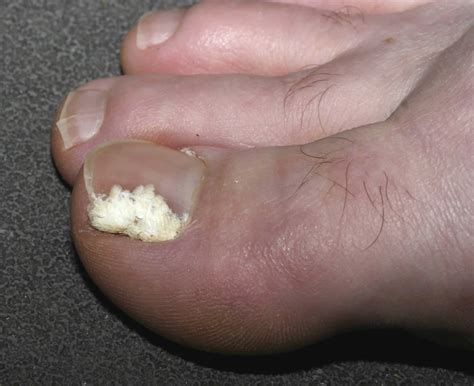 Fungal Nail Infection How Long To Clear at Gene Pettitt blog