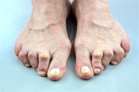 Feet Of Woman Deformed From Rheumatoid Arthritis — Stock Photo © Hriana ...