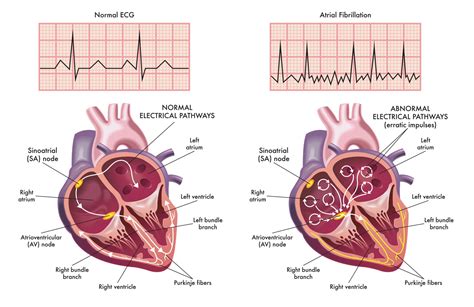 Difference between Atrial Fibrillation and Atrial Flutter - Pulse ...