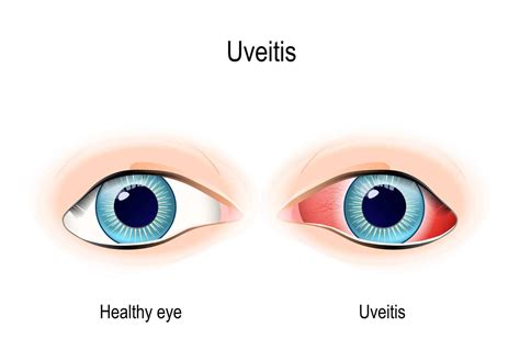 Uveitis Eye