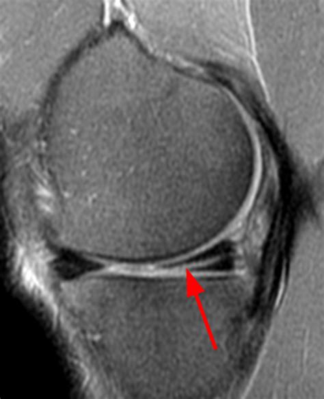 8. mri meniscus tear - Dr. Yves Depaepe