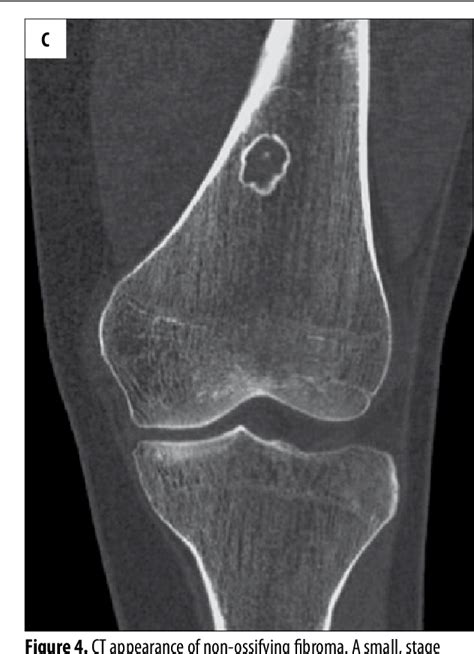 Figure 4 from Cortical fibrous defects and non-ossifying fibromas in ...