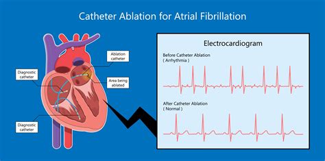 Ventricular Flutter Vs Fibrillation