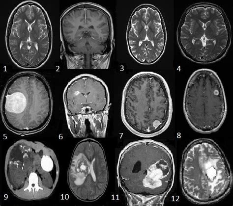 Sample datasets of brain tumor MRI Images Normal Brain MRI (1 to 4 ...