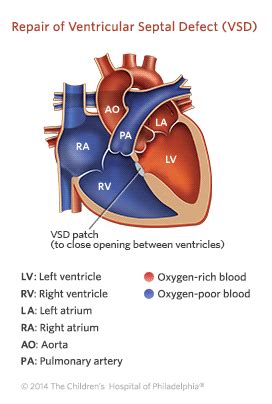 Ventricular Septal Defect (VSD) | Children's Hospital of Philadelphia