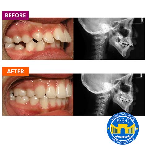 Overbite - Manhattan Bridge Orthodontics