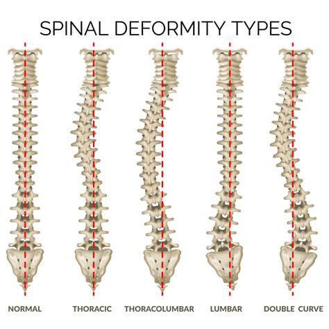 Scoliosis - Hey Clinic