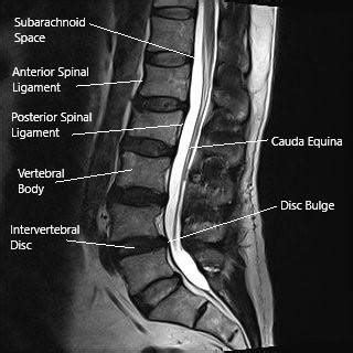 Prolapsed Intervertebral Disk (PIVD) - Complete Orthopedics