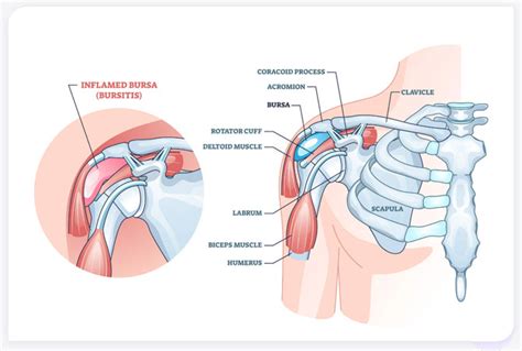 Non-Surgical Treatment for Shoulder Bursitis in Solana Beach, CA