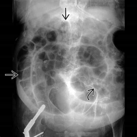 Ileus | Radiology Key