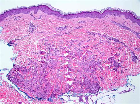 Erythema Annulare Centrifugum Histology