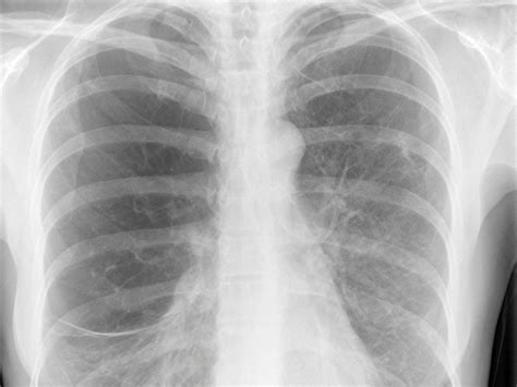 Healthy Lungs Vs Smokers Lungs X Ray