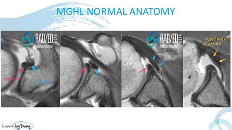 GLENOHUMERAL LIGAMENTS MRI ANATOMY: MIDDLE GLENO HUMERAL LIGAMENT HOW ...