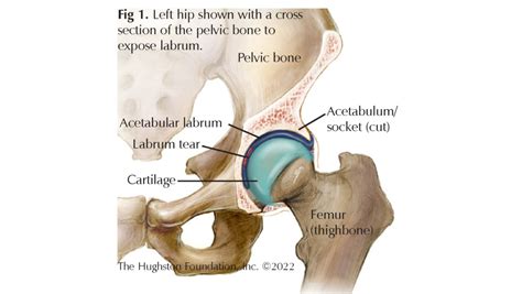 Hip Labral Tear - Hughston Clinic