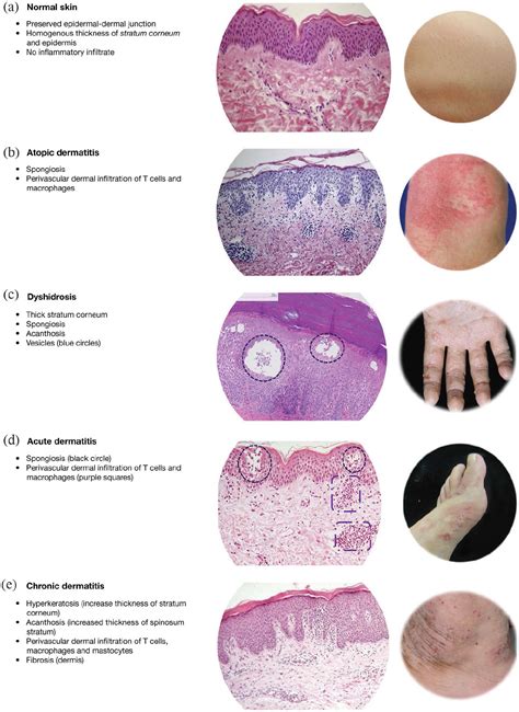 Nomenclature and clinical phenotypes of atopic dermatitis - Giampiero ...