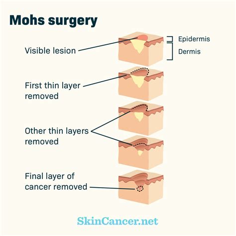 Mohs Surgery as a Skin Cancer Treatment Option | SkinCancer.net