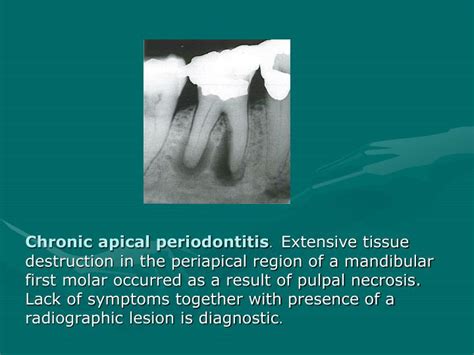 PPT - PERIAPICAL DISEASE PowerPoint Presentation - ID:5428589