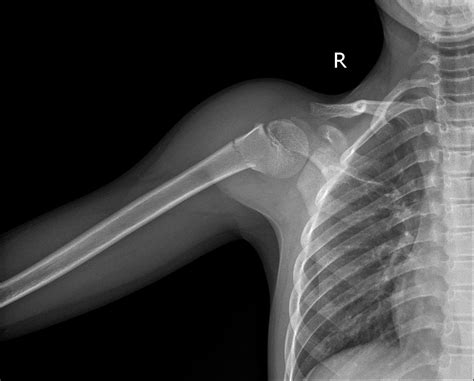 Greenstick Fracture Humerus