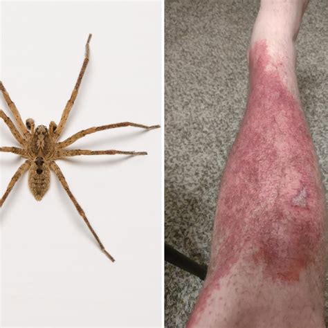 Brown Recluse Spider Bite Rash