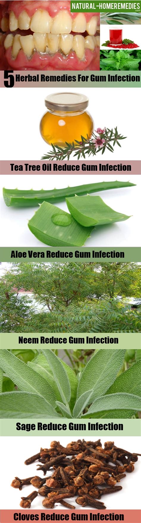 Top 5 Herbal Remedies For Gum Infection – Natural Home Remedies ...