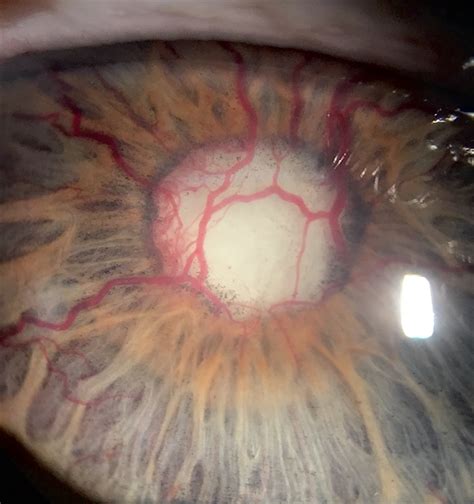 Neovascular Glaucoma - Retina Image Bank