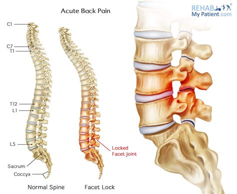 Acute Back Pain | Rehab My Patient