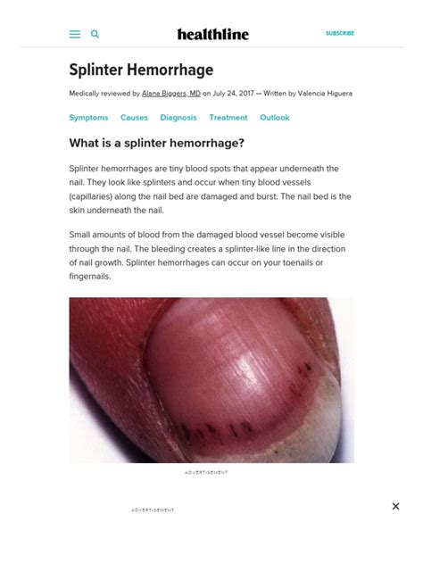 Splinter Hemorrhages - Symptoms, Causes, and Treatments PDF | PDF ...