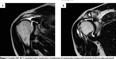 Figure 1 from Magnetic Resonance Imaging of Rotator Cuff Tears in ...