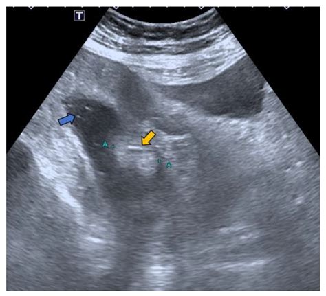 Lipoma Ultrasound Treatment - Infoupdate.org