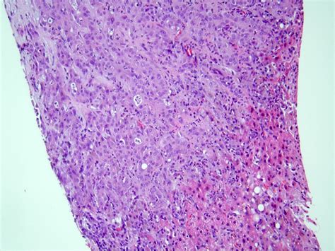 Pathology Outlines - Intrahepatic cholangiocarcinoma (small and large ...